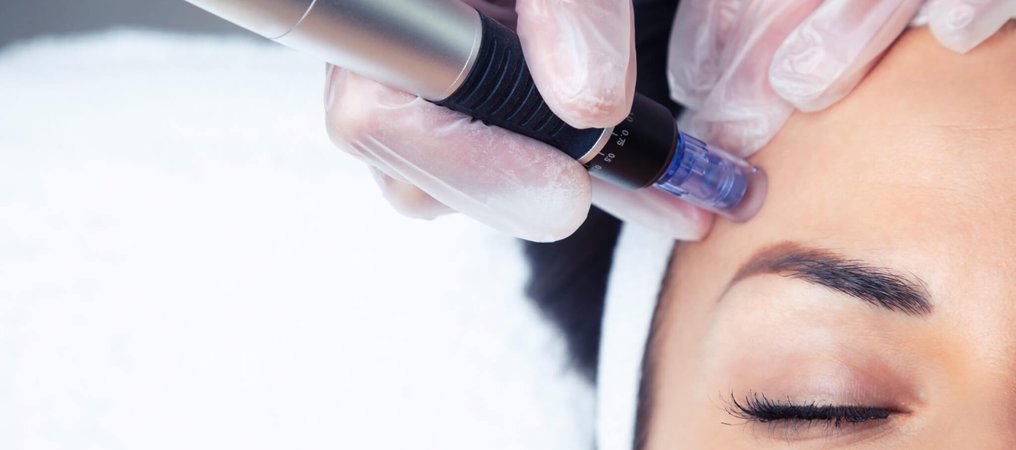 Microneedling Day